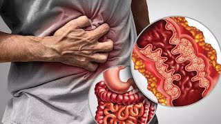 What Is Crohns DiseaseGASTROINTESTINAL DISORDER [upl. by Azila288]