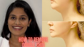 Double chin treatment in Hyderabad Telugu [upl. by Sunshine]