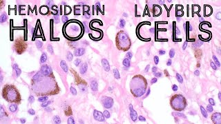 Hemosiderin Halos  Ladybird Cells in Giant Cell Tumor of Tendon Sheath pathology dermpath [upl. by Esina821]