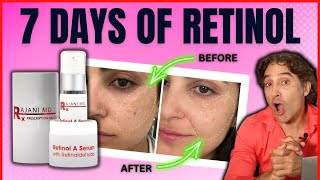 🔺RETINOL BEFORE And AFTER HALF Of HER FACE 🔺  Retinol Serum [upl. by Asselim]