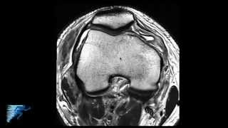 PLC Injury Knee MRI  Posterolateral Corner Knee Injury  Knee Pain Symptoms  Minneapolis MN [upl. by Zenia]