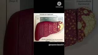 Fibrosis of liver mbbs fattyliver hepatitisc viralshort youtubeshorts shorts fibrosis [upl. by Fai]