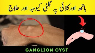 Ganglion cyst causes symptoms and treatment  Wrist ganglion cyst explained [upl. by Erbes]