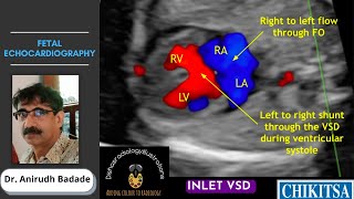 Fetal Echocardiography Basics Ultrasound  Dr Anirudh Badade [upl. by Navaj]