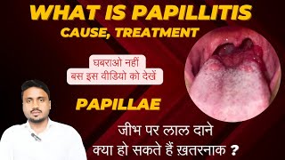 What is papillae Tongue papillitis cause treatment tonguepapillitis papillaeontongue imk [upl. by Ylak185]