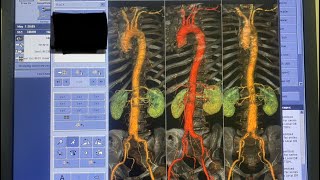 CT Angiography Thoracic ampAbdominal Aorta Patient With Abdominal aneurysmGE OPTIMA CT Multislice 16 [upl. by Rozele]