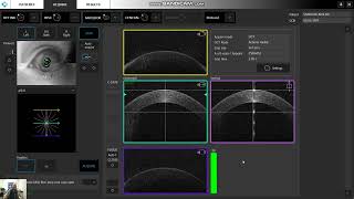 How to use Adjusted IOP correction factor [upl. by Nosinned]