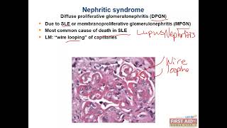 Nephritic Syndrome and Nephrotic SyndromeRenal pathology video part2 from USMLE First Aid Step One [upl. by Yasdnyl]