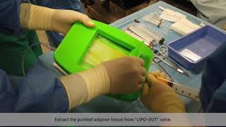 LIPOSTEM™surgical session Hip osteoarthritis treatment with adiposederived mesenchymal stem cells [upl. by Ranna]