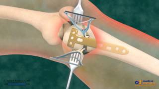 High Tibial Osteotomy HTO for Bow Leg Correction [upl. by Nefets164]