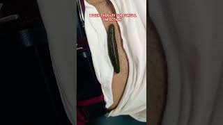 Leech Therapy For Fungal Infection leechtherapy ytshorts [upl. by Cutty]