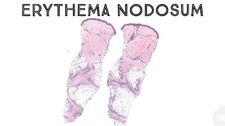 Erythema nodosum panniculitis subcutaneous nodules fat necrosis dermatology pathology dermpath [upl. by Aicelf]