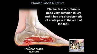 Rupture of the Plantar Fascia  Everything You Need To Know  Dr Nabil Ebraheim [upl. by Aninaj159]