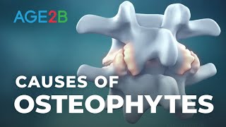 What Causes Osteophytes  Prevalence  Degenerative Disc Disease [upl. by Acsicnarf885]