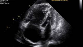 Pulmonary Hypertension echo [upl. by Olzsal267]