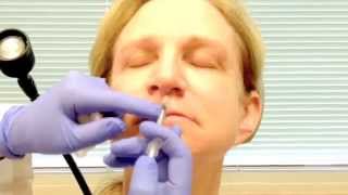 Botox tip nose lift [upl. by Lauder941]