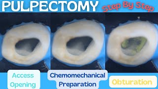 Pulpectomy ⚪️ Step By Step Demonstration 🔵 Baby Blue Pediatric Rotary Endodontic Files [upl. by Aileon449]