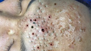 blackheads lipsl Acne treatment l Extraction cysts and blackheads l blackheads lips [upl. by Aelyak]