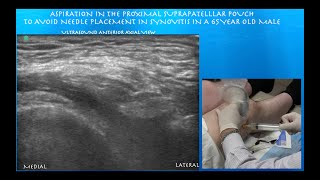 Ultrasound Guided Knee Aspiration amp Injection [upl. by Selemas]