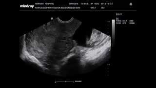 LIVE ABDOMINAL ECTOPIC PREGNANCY OF 14 WEEKS [upl. by Llezom]