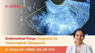 Endometrial Polyp Diagnosis by Transvaginal Ultrasound  Dr Shilpa G B [upl. by Gudrun]