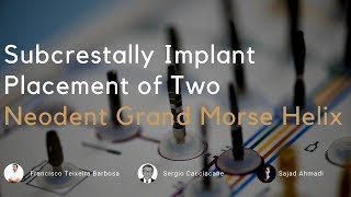 Implant placement of 2 GM Grand Morse Helix to restore two molars [upl. by Fredrick]