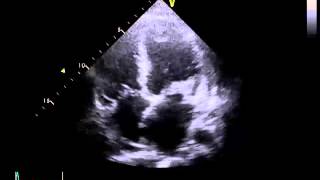 Echocardiography to Assess MitralValve Leaflets  NEJM [upl. by Micro]