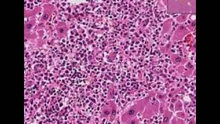 Histopathology LiverAcute myeloid leukemia [upl. by Iror]