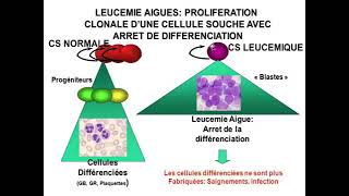 Hemato 12Hémopathies malignes et leucémies aigues Dr Abbadi [upl. by Gracia]