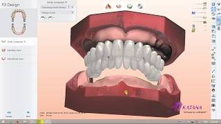 Digital Full Dentures Design Colour Scan [upl. by Olra]