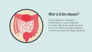 Crohn Disease Signs Symptoms Causes and Treatment  Merck Manual Consumer Version [upl. by Dexter]