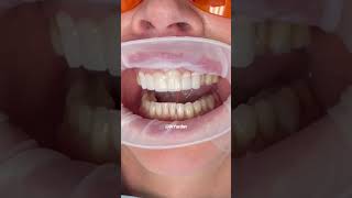 Smile transformation  porcelain crowns front teeth  dental veneers procedure  Dr Yazdan veneers [upl. by Arny]