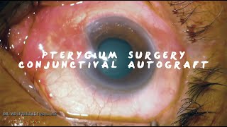 MIIQ 97 Pterygium Surgery Conjunctival Autograft with Sutures  DR MD IFTEKHER IQBAL RAJU [upl. by Wilmer22]