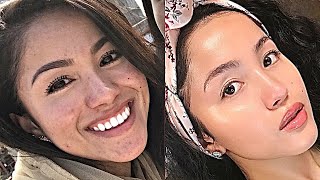 How I Cured My Hormonal acne  My Acne Journey  Night Skincare Routine [upl. by Anitnatsnoc]