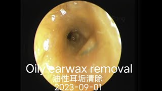 Oily earwax removal油性耳垢清除20230901 [upl. by Kristofor358]