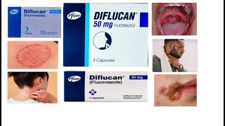 Diflucan tablet  Uses  Side effects  HindiUrdu [upl. by Aneeras]