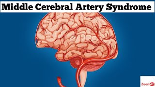 Middle Cerebral Artery SyndromeMiddle Cerebral Artery StrokeZeenad Learning Hub [upl. by Farant]