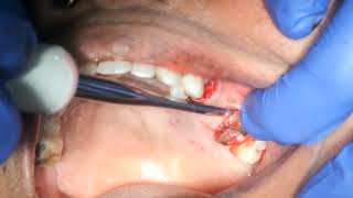 Upper premolar root stump and molar root stump extraction video [upl. by Mackintosh]