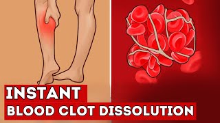 These 7 FOODS Instantly Dissolve Blood Clots in Your Vessels [upl. by Akem784]