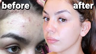 HOW I CLEARED MY SKIN  BENZOYL PEROXIDE FOR ACNE [upl. by Aleehs]