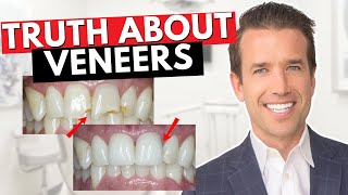 Before you get Dental Veneers Watch This  Are Veneers Worth It [upl. by Kelila]