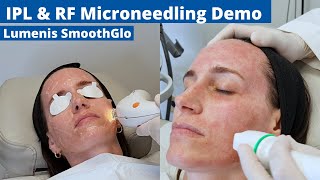 Intense Pulsed Light amp Radio Frequency Microneedling Treatment Demo  Lumenis SmoothGlo [upl. by Eissirk]