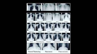 all chest xray normal vs abnormal diagnosis respiratorydiseases Sudarshanlipane17 💫🩺🏥🎉✨⛑️ [upl. by Ddal]