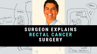 Surgeon Explains Rectal Cancer Surgery [upl. by Zullo901]