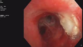 Central Airway Tumor  Bronchoscopic recanalisation  Pleomorphic adenoma [upl. by Aianat]