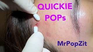 Quickie keratin plug core pops Acne extractions Link below to MrPopZit Live [upl. by Virgie]