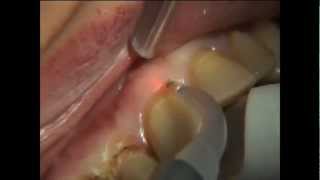 PHILIPS LASERS Gingivectomie multiple 1 [upl. by Salzhauer]