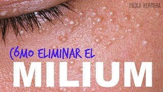 Granitos en los ojos CÓMO ELIMINAR EL MILIUM [upl. by Ardell]