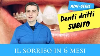 Denti dritti subito  quotIl sorriso in 6 mesiquot [upl. by Anire]