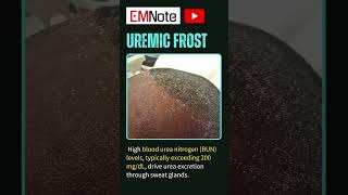 Uremic Frost of ESRD nursing doctor medical [upl. by Savina]